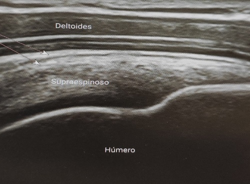 Ultrasound Supraspinatus Tendon