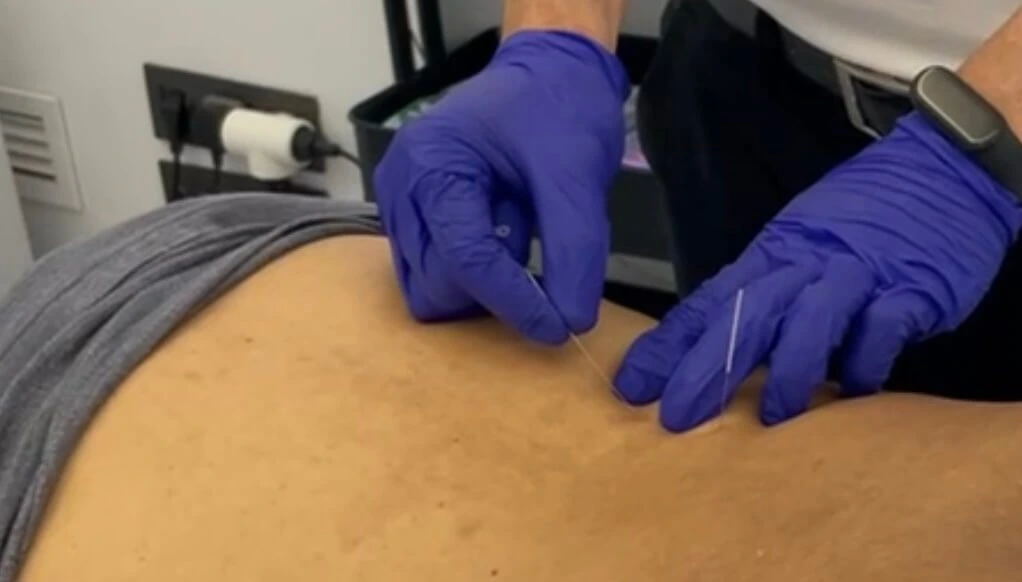Dry Needling