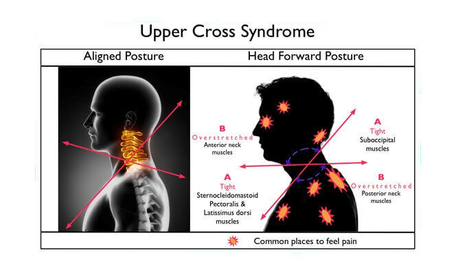 Upper Cross Syndrome